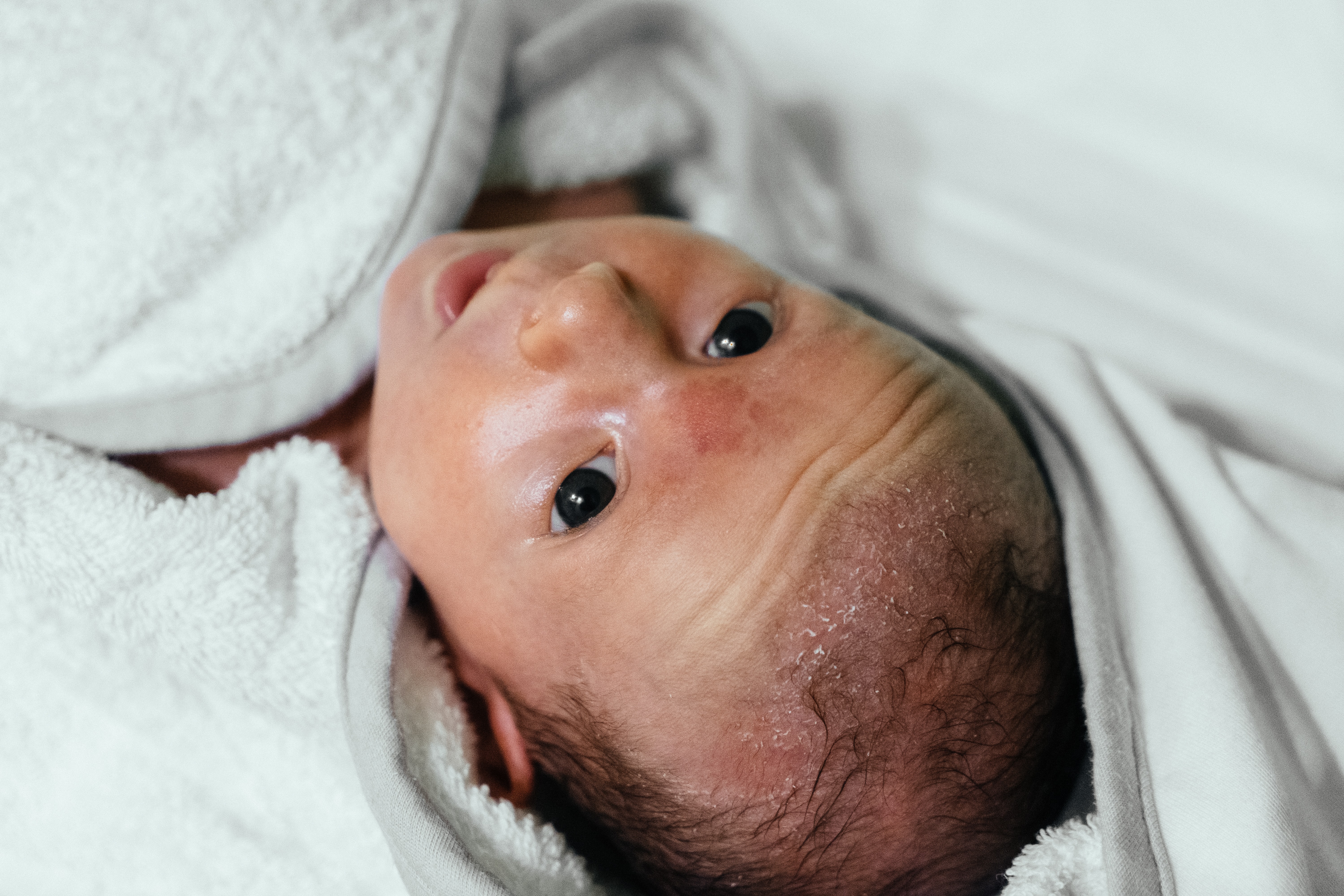 bloem Normaal gesproken chatten Van acne tot eczeem: alles over huiduitslag bij baby's